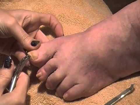 Pedicure Big Toenail Buildup Cut Trumpet Toenail with High Hyponychium and Cuticle Buildup